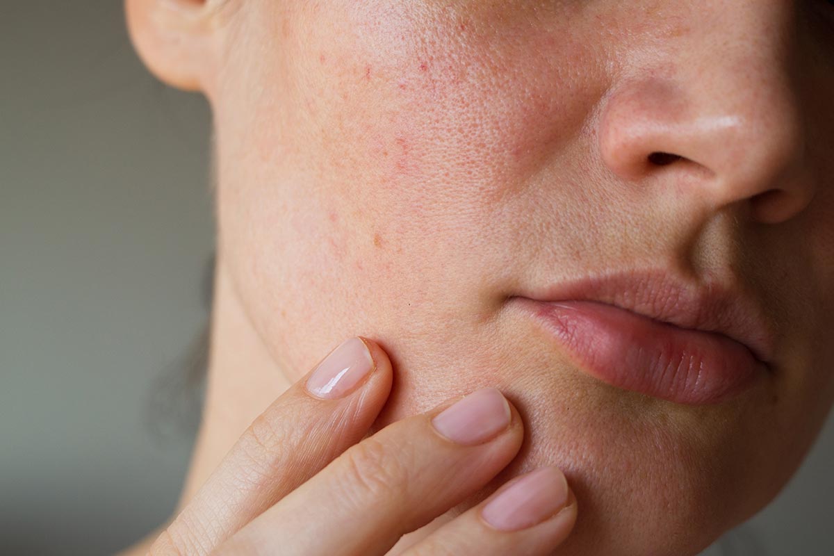 como saber que tienes rosacea como saber que tienes rosacea